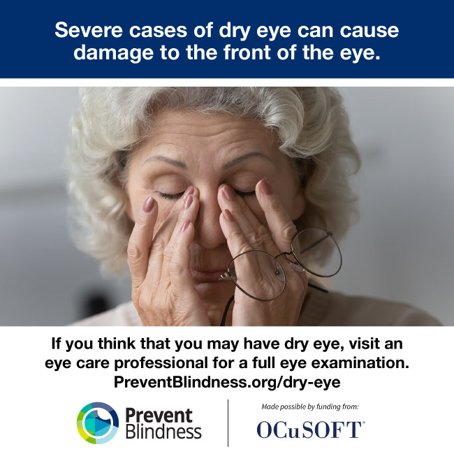 Prevent Blindness Joins in July’s Dry Eye Awareness Month, Providing Educational Resources on Eye Disease that Affects Millions