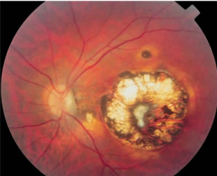 Cicatriz retinocoroidea macular causada por toxoplasmosis ocular