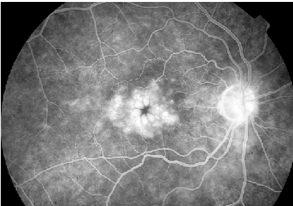 Fig 3. Edema macular quístico por fluorangiografía