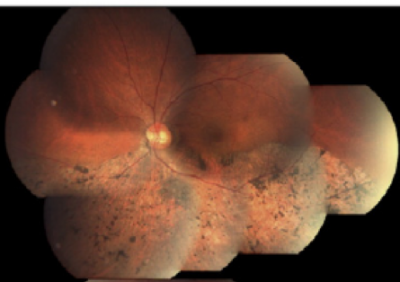 Figura 2.- Fondo de ojo (OI) de un paciente con retinosis pigmentaria. Las distrofias retinianas son enfermedades monogénicas en las que la mutación de alguno de más de 200 genes es la causa de la enfermedad. La secuenciación de siguiente generación permite el análisis simultáneo de cientos o miles de genes con lo que el diagnóstico genético de este grupo de enfermedades se ha visto facilitado enormemente.