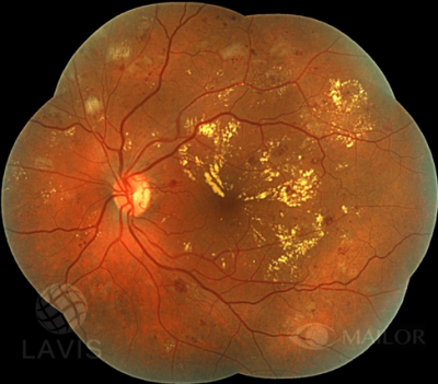 Foto1. Retinopatia Diabética Moderada. Se observan las hemorragias y exudados o salida de proteínas de vasos dañados comprometiendo el centro de la visión.