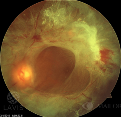 foto 2. Retinopatia Diabética avanzada, obsérvese la retina desprendida con gran daño por fibrosis y vasos anormales.