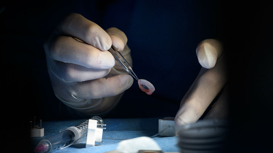 Dr Mark Mannis lifts the donor rim before separating the cornea/ Story: A new global data project on human tissue use in corneal transplantation