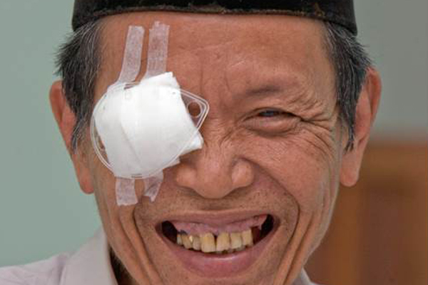 An East Asian man with a patch on his right eye, with a wide smile--post cataract surgery