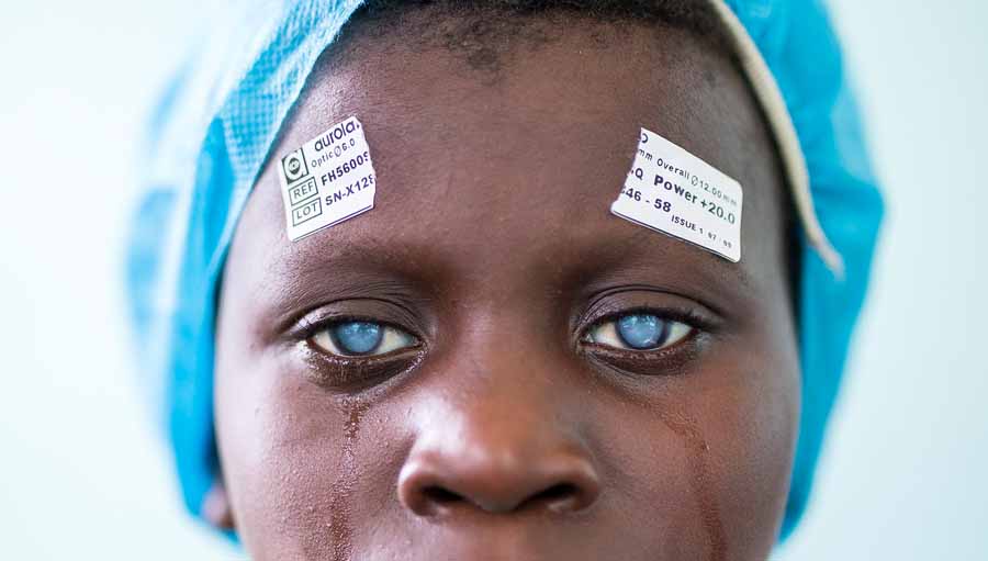 Webinar: Primary Eye Care Training Manual. 7-year-old Mebdji is treated for bilateral cataract by Dr Richard Hardi in the D. R. Congo / Photo credit: Andras D. Hajdu