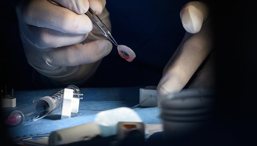 Síndrome de Burn out y su impacto en la formación del residente. Dr Mark Mannis lifts the donor rim before separating the cornea using a trephine tool onboard the Orbis Flying Eye Hospital on April 20, 2018 in Trujillo, Peru. Photo by Leon Neal.