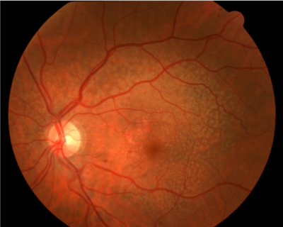 retina image