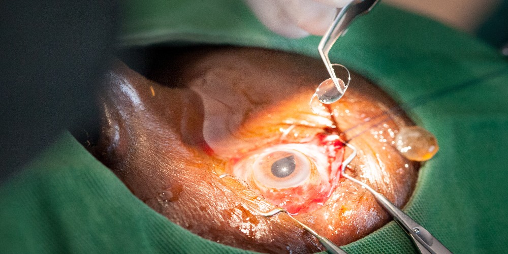 Close-up of cataract surgery at an eye care outreach site.